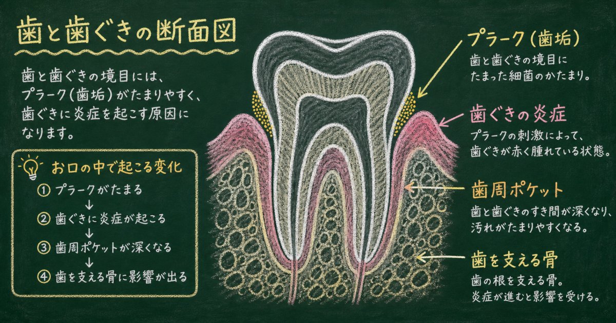 歯磨きで歯ぐきから血が出る主な原因とメカニズム