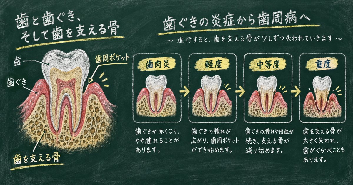 45歳からの歯周病対策|進行度別の症状と歯を失う仕組みを解説